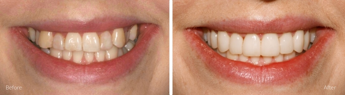 Emma S. — Crowding & Alignment before and after Invisalign at Erskine Park Dental