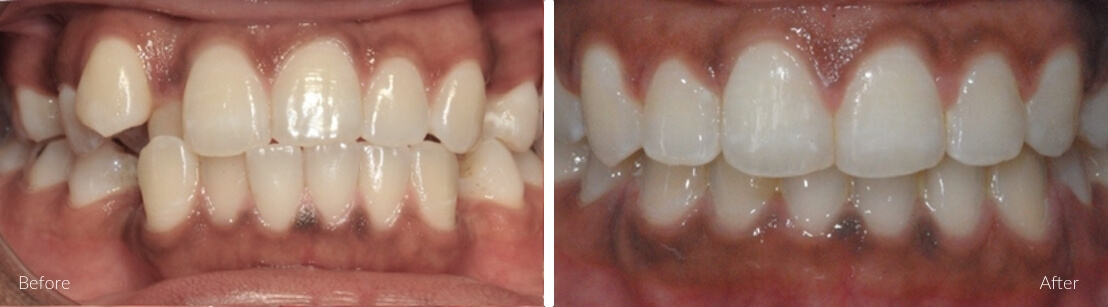 Daniel R. — Crossbite Correction before and after Invisalign at Erskine Park Dental